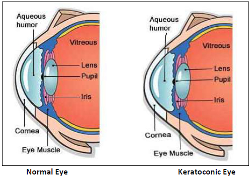 Keratoconus