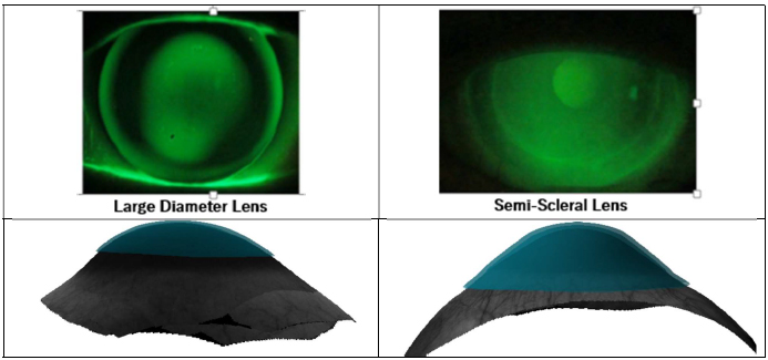 Keratoconus