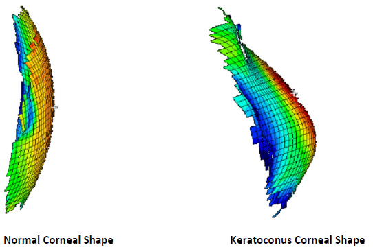 Keratoconus